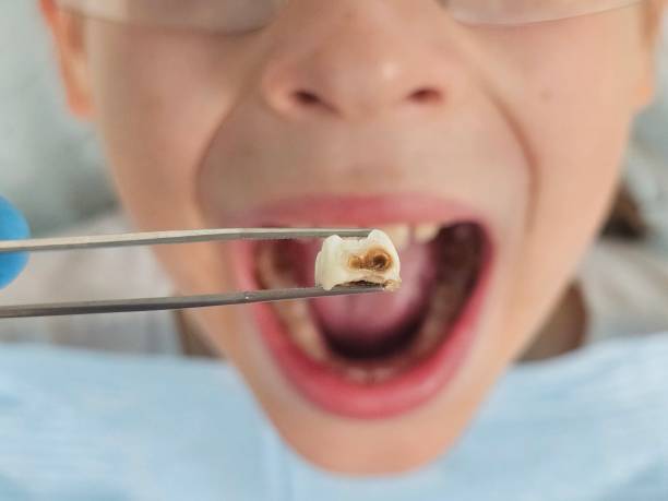 Best Emergency Tooth Extraction in Martin, SD